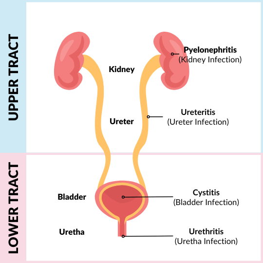 lower tract vs upper tract comparison